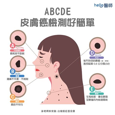 容易長痣|是痣or皮膚癌？醫「1張圖秒對照」 長這2部位最危險